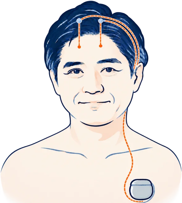 DBSの仕組みの図：頭部に留置した刺激電極（リード）が、前胸部の皮下に植え込んだ刺激装置とつながっている様子