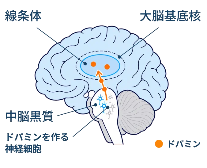 パーキンソン病の脳の模式図。中脳黒質のドパミンを作る神経細胞が減り、線条体に届くドパミンが少なくなっている。