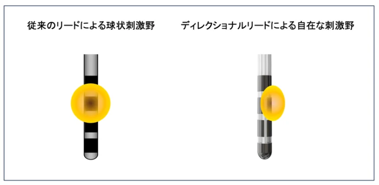 従来の電極とディレクショナルリードの刺激範囲の違いを示した図
