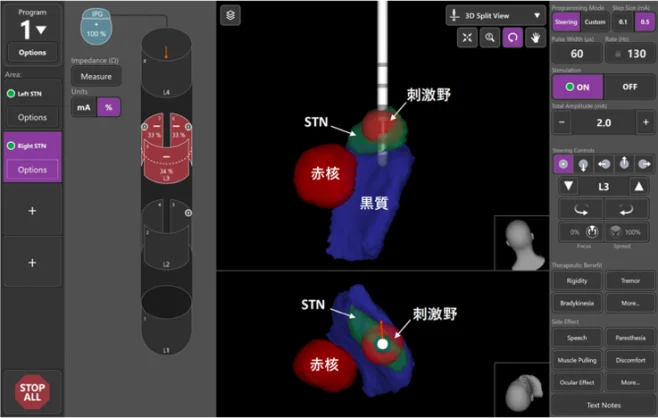 画像ガイドプログラミングの画面例。脳の構造と電極、刺激が及ぶ範囲が表示されている